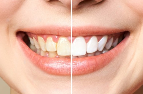 Maintain teeth whitening